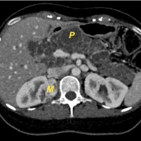 Axial section of a contrast-enhanced CT scan of the abdomen showing an enlarged pancreas (P) with innumerable cysts replacing