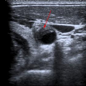 A and C: Neck ultrasound. B: Colour Doppler ultrasound of the neck. Lateral eccentric hypoechoic adventitial thickening of the left common carotid (red arrow).