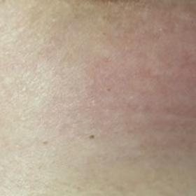 Photography. Initial breast appearance showing inflammatory changes and regional cutaneous reddening