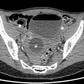 Arterial phase axial CT of the pelvis demonstrating abnormal myometrial enhancement ( arrows) thought to represent the AVM wi