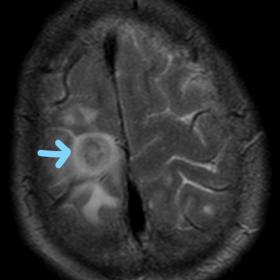 (1A & 1B; T2w axial): At initial presentation heterogeneous juxtacortical lesions (block arrows) are seen in the right fronta