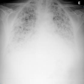 Chest radiography with bilateral diffuse nodular pattern