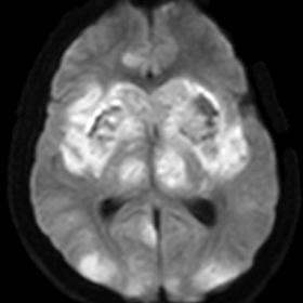 Patchy areas of restricted diffusion involving bilateral cerebral cortex, bilateral basal ganglia and thalami