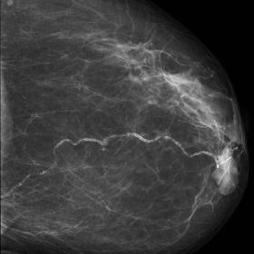 High density, oval nodule with circumscribed margins located in the inferior retroareolar region of the left breast.