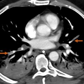 CT pulmonary angiogram demonstrating pulmonary thrombi in the lingular artery and right lower lobe lateral segmental