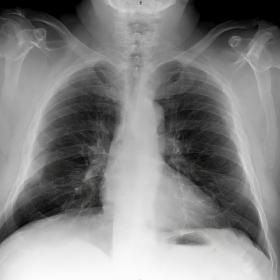 Chest X-ray. Soft tissue enlargement in the right inferolateral region with well-defined and air-density structure at the ips