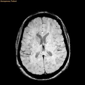 Microbleeds in Corpus Callosum. Disseminated oval and linear microbleeds predominantly located in the corpus callosum, subcor