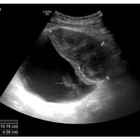 B-mode US detects a biconvex inhomogeneous lesion (between calipers) in contact with the left anterior wall of the urinary bl