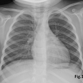 Chest radiograph in frontal projection demonstrates no significant abnormality