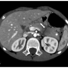 (a)Axial section of abdominal CT with contrast shows a linear non-enhancing defect (solid white arrow) extending antero-poste