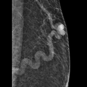 Left breast mammography depicts a breast with fat content, highlighting a thick and tortuous structure with a vascular appear