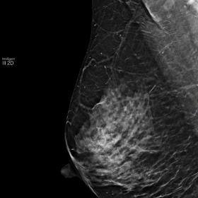 Patient 1. Oblique views of both breasts show axillary lymph nodes, slighly more prominent on the left side (B). No obvious b