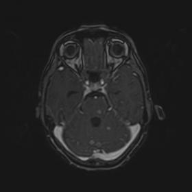Axial gadolinium enhanced T1 weighted image showing nodular and ring enhancing lesions in cerebellum and brainstem