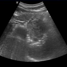 Ultrasound image of the lesion. Image depicts a large well-circumscribed hypoechoic mass with through-transmission in the tail of the pancreas