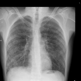 First posteroanterior (PA) chest X-ray. Bilateral, peripheral alveolar-interstitial opacities, predominantly in both lung bas