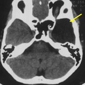 Axial section of unenhanced computed tomography (CT) of head shows an extra-axial lesion of fluid density filling the middle 