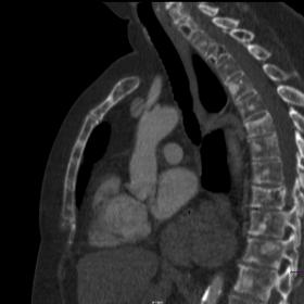 Sagittal CT image of the thoracic spine demonstrating numerous sclerotic lesions