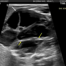 Axial ultrasound sections through the abdomen reveal a large multiloculated cystic mass (white arrow)  with septations and ec
