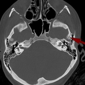 NECT of the brain showing fracture of the left temporal bone