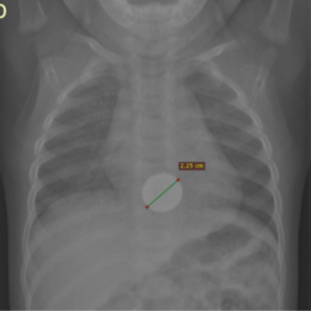 Frontal chest radiograph with a round, 23-mm diameter and radiopaque foreign body projected over the distal oesophagus