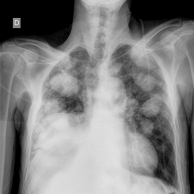 PA Chest X-ray with bilateral low density pulmonary masses and right diaphragmatic elevation