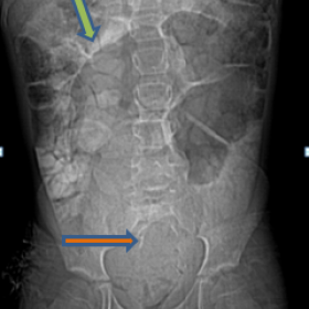CT TOPOGRAM of an 18-month-old female child showing scimitar sacrum, soft tissue opacity in pelvic cavity (orange arrow) and 