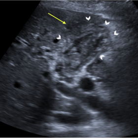 Longitudinal image at the right hypochondrium shows a non-distended gallbladder with diffuse and irregular wall thickening (w