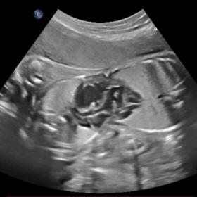 Antenatal ultrasonography of the abdomen. Grey scale and colour Doppler images showing complex cardiac fusion in conjoined tw