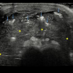 Ultrasonography of the dorsum of the penile shaft shows multiple mobile hyperechoic foci with posterior reverberation artefac