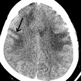 NCCT Brain axial images above the level of lateral ventricles show bilateral asymmetric white matter hypodensity also involvi