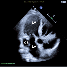 Transthoracic echocardiography (apical three chamber view) show dilatated coronary sinus (CS), Left atrium (LA), Left ventricle (LV)