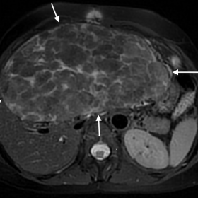 Axial T2-weighted image with fat suppression of the superior abdomen shows a large, well-defined hepatic mass with heterogeneous signal intensity, multiple thick and confluent septa and areas of low signal intensity, which suggested a fibrous component. White arrows delineate the lesion’s borders