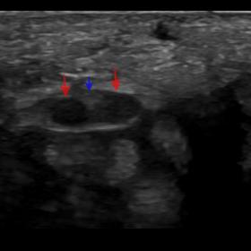 Ultrasound of the BMN (red arrows) with PMA (blue arrow) at the level of the distal forearm