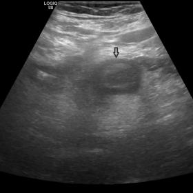 Abdominal ultrasound images at the level of the right iliac fossa, in the axial (a) and longitudinal (b, c) planes of a bowel