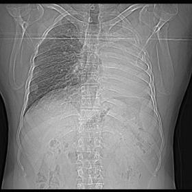 Frontal chest radiograph shows left opaque hemithorax with cardiomediastinal shift to left. Compensatory hyperinflation of ri