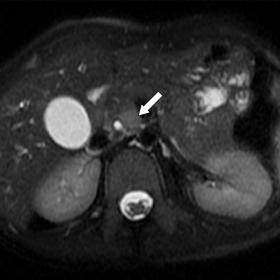 In the internal portion of the pancreatic head, an ill-defined 18 mm lesion, hyperintense on T2WI-FS (arrow, a), and hypointe
