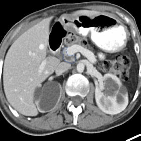Contrast enhanced CT in two consecutive axial slices (1a, 1b) revealing the absence of pancreatic parenchyma in the neck, bod