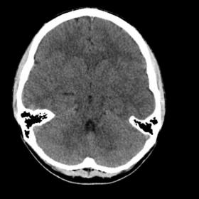 Initial CT brain non-contrast, no acute intracranial abnormality seen