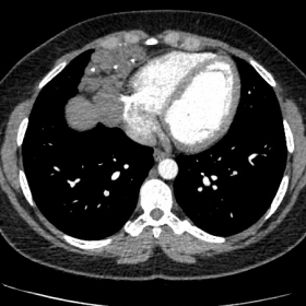 Pre-operative CT PA axial. CT PA showing right paracardiac anterior mediastinal soft tissue density with calcifications