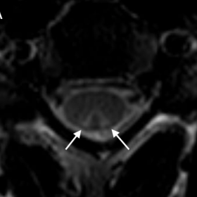 Axial T2W MRI of the cervical spine. On this axial T2-weighted image performed at C3-C4 level an inverted V-shaped hyperinten