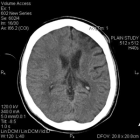 CT Head plain study reveals left frontal lobe cerebral atrophy