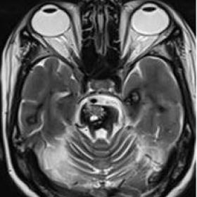 Multiple T2 hyperintense lesion with peripheral hypointense rim noted in the bilateral cerebral hemisphere, cerebellarhemisph
