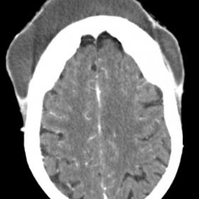 Axial Contrast-Enhanced Computed Tomography (CE-CT) shows a large tender swelling on the forehead, with a peripheral rim of e