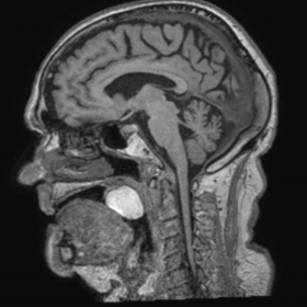 MRI sagittal T1-weighted image showing very hyperintense round mass in the left lateral wall of the oropharynx. The lesion ha