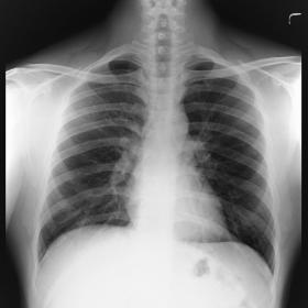 Chest radiograph showing prominent vessels in the right lower zone