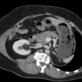 Axial post-contrast venous phase oblique CT shows a right renal hilum fat mass, with no intrinsic enhancement, extending to t