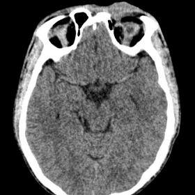 Non contrast CT brain axial image showing soft tissue lesion in left superior palpebral region
