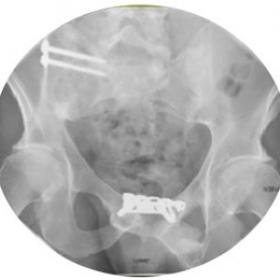 AP (a) and lateral (b) xrays of pelvis. Demonstrating pelvic fixation with screws running in anteroposterior direction