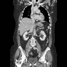 Coronal CT slice with normal findings