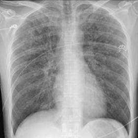 Frontal supine thoracic x-ray: symmetrical diffuse hazy alveolar opacities most apparent in the dependent lung regions